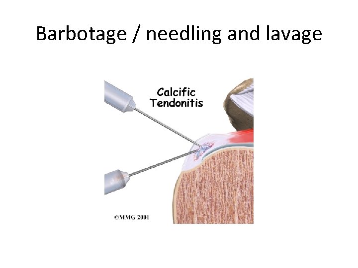 Barbotage / needling and lavage 