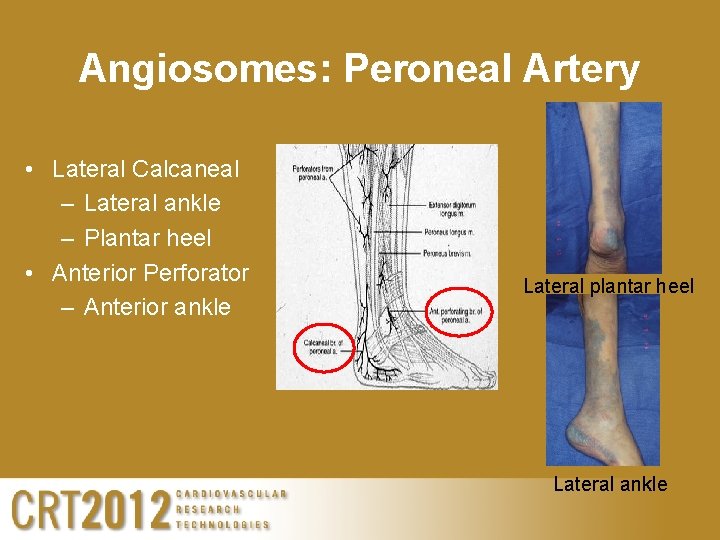 Angiosomes: Peroneal Artery • Lateral Calcaneal – Lateral ankle – Plantar heel • Anterior