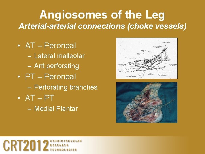 Angiosomes of the Leg Arterial-arterial connections (choke vessels) • AT – Peroneal – Lateral