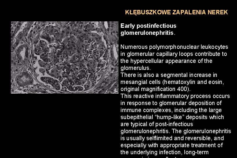 KŁĘBUSZKOWE ZAPALENIA NEREK Early postinfectious glomerulonephritis. Numerous polymorphonuclear leukocytes in glomerular capillary loops contribute