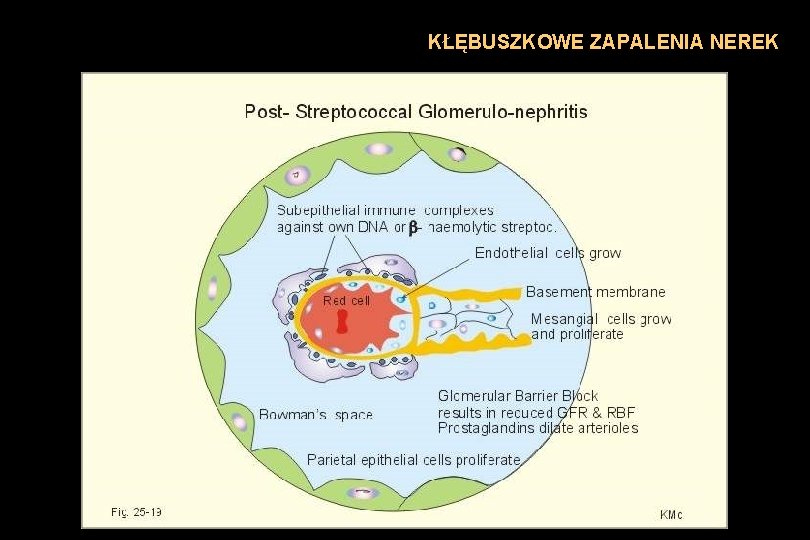 KŁĘBUSZKOWE ZAPALENIA NEREK 