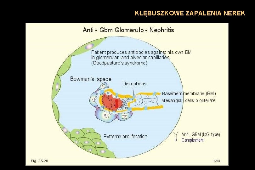 KŁĘBUSZKOWE ZAPALENIA NEREK 