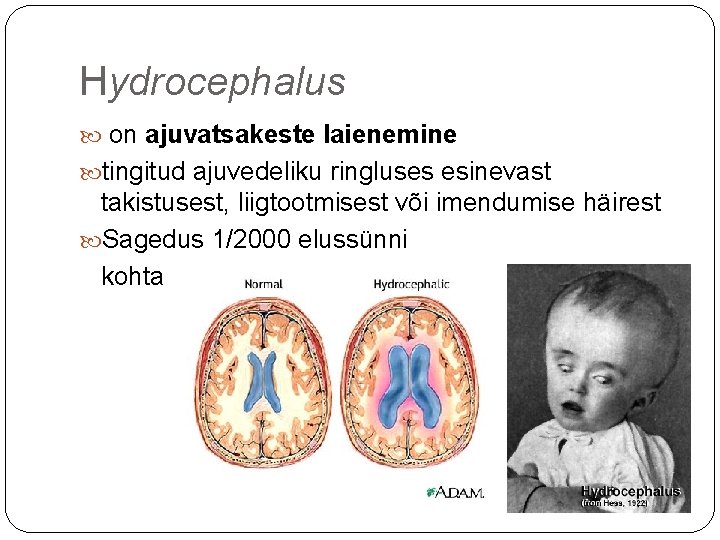 Hydrocephalus on ajuvatsakeste laienemine tingitud ajuvedeliku ringluses esinevast takistusest, liigtootmisest või imendumise häirest Sagedus