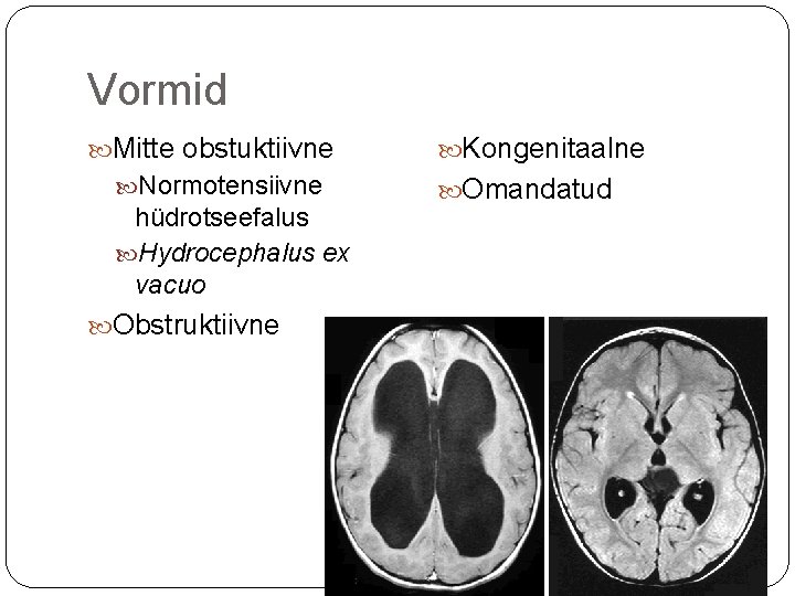 Vormid Mitte obstuktiivne Normotensiivne hüdrotseefalus Hydrocephalus ex vacuo Obstruktiivne Kongenitaalne Omandatud 