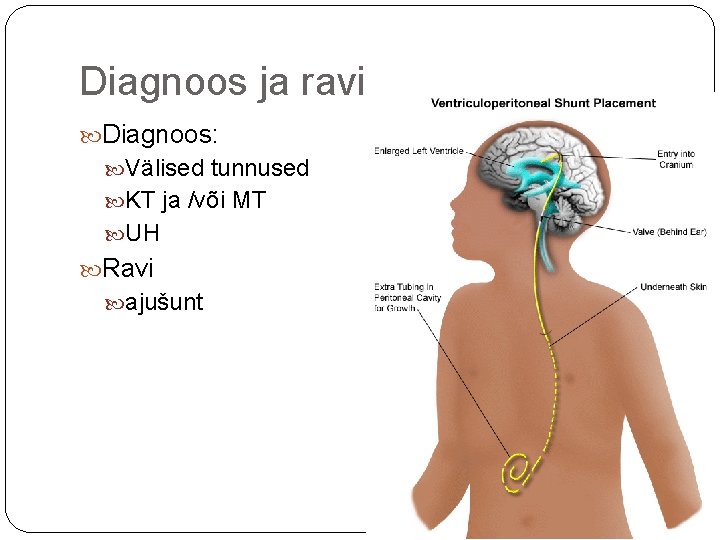 Diagnoos ja ravi Diagnoos: Välised tunnused KT ja /või MT UH Ravi ajušunt 