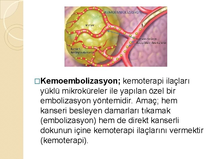 �Kemoembolizasyon; kemoterapi ilaçları yüklü mikroküreler ile yapılan özel bir embolizasyon yöntemidir. Amaç; hem kanseri