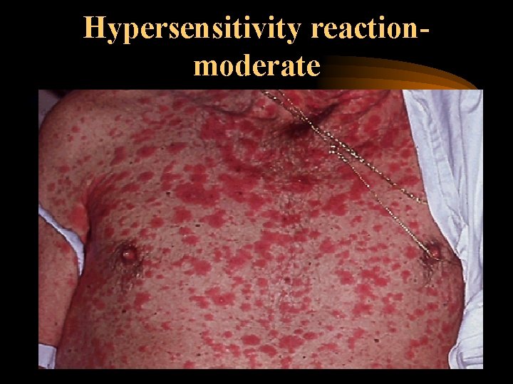 Hypersensitivity reactionmoderate 