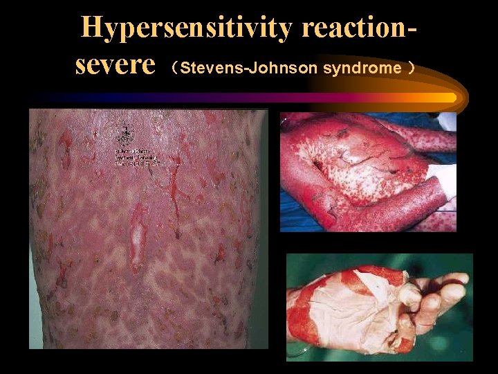 Hypersensitivity reactionsevere （Stevens-Johnson syndrome ） 