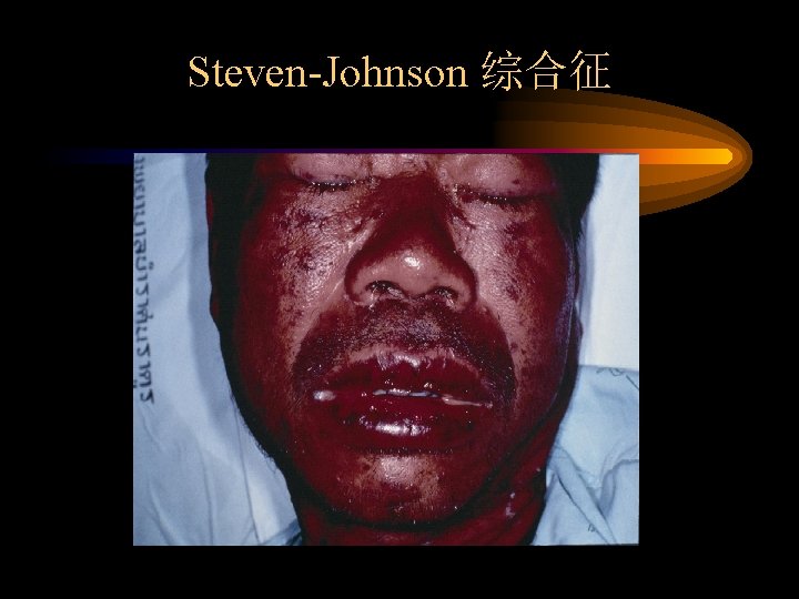 Steven-Johnson 综合征 