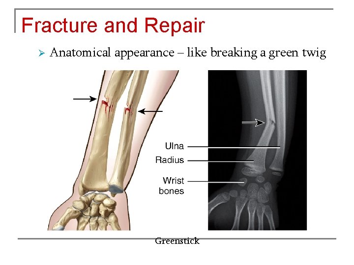 Fracture and Repair Ø Anatomical appearance – like breaking a green twig Greenstick 