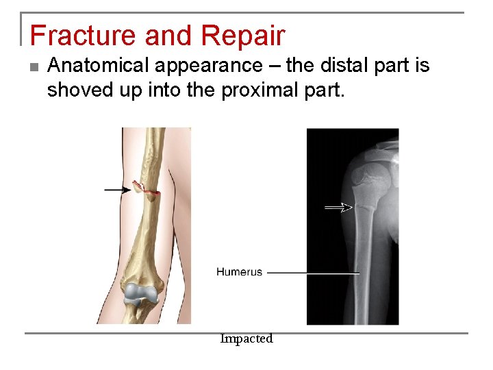 Fracture and Repair n Anatomical appearance – the distal part is shoved up into