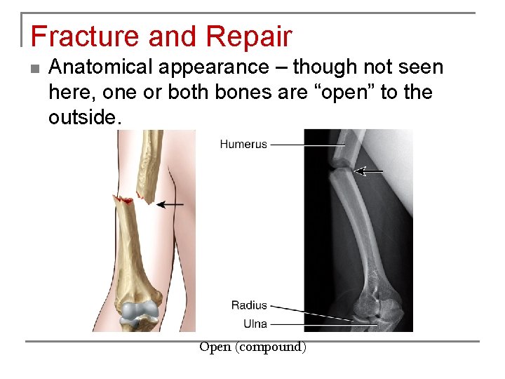 Fracture and Repair n Anatomical appearance – though not seen here, one or both