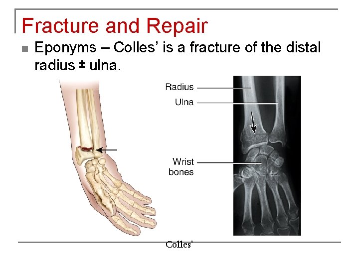 Fracture and Repair n Eponyms – Colles’ is a fracture of the distal radius