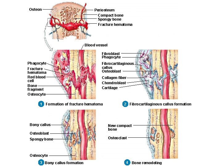 Osteon Periosteum Compact bone Spongy bone Fracture hematoma Blood vessel Fibroblast Phagocyte Fracture hematoma