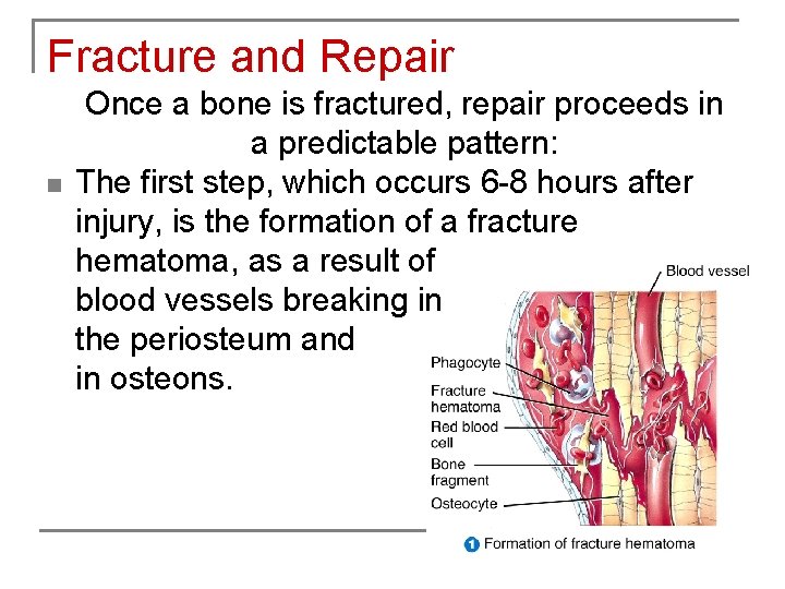 Fracture and Repair n Once a bone is fractured, repair proceeds in a predictable