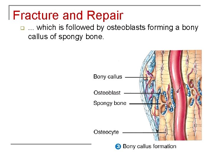 Fracture and Repair q . . . which is followed by osteoblasts forming a