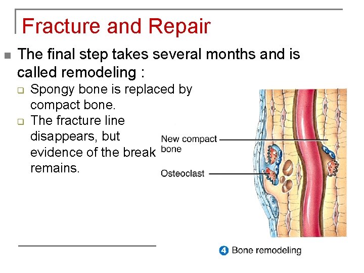 Fracture and Repair n The final step takes several months and is called remodeling
