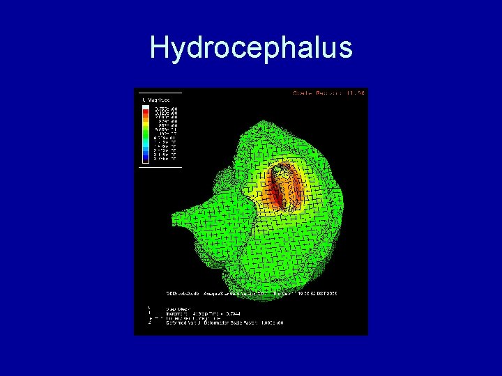 Hydrocephalus 
