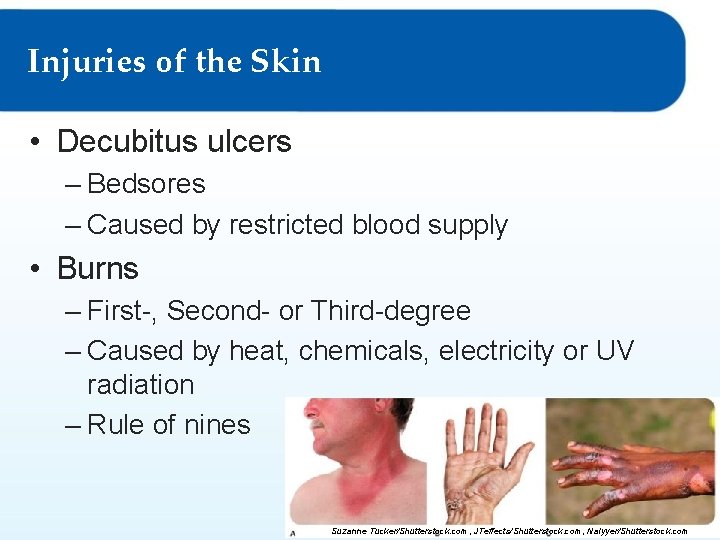 Injuries of the Skin • Decubitus ulcers – Bedsores – Caused by restricted blood