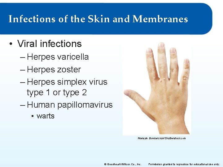 Infections of the Skin and Membranes • Viral infections – Herpes varicella – Herpes