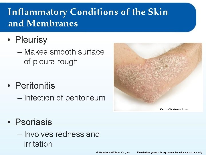 Inflammatory Conditions of the Skin and Membranes • Pleurisy – Makes smooth surface of