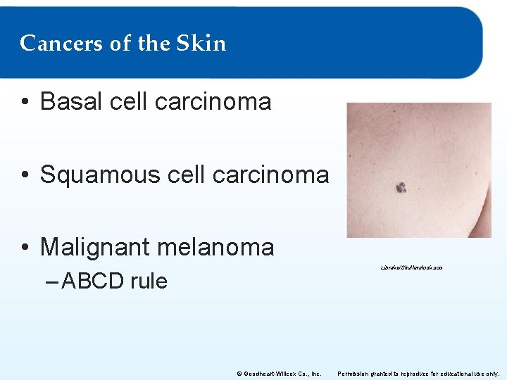 Cancers of the Skin • Basal cell carcinoma • Squamous cell carcinoma • Malignant
