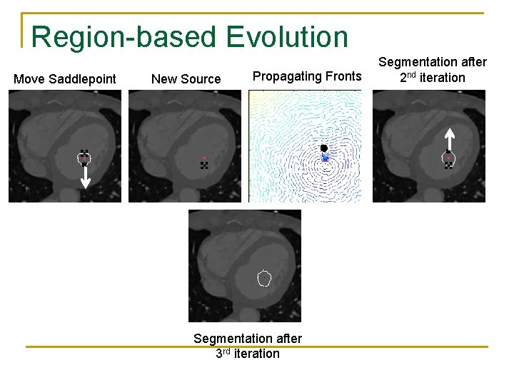 Region-based Evolution Move Saddlepoint New Source Propagating Fronts Segmentation after 3 rd iteration Segmentation