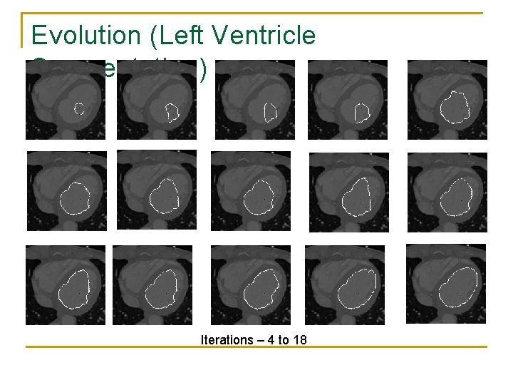 Evolution (Left Ventricle Segmentation) Iterations – 4 to 18 