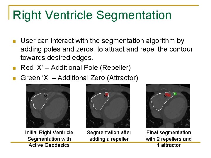 Right Ventricle Segmentation n User can interact with the segmentation algorithm by adding poles