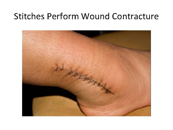 Stitches Perform Wound Contracture 