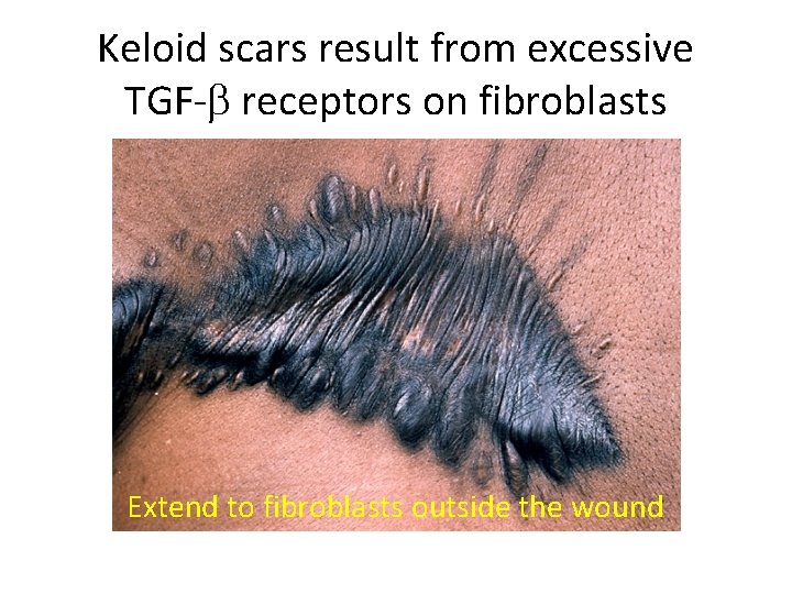 Keloid scars result from excessive TGF-b receptors on fibroblasts Extend to fibroblasts outside the