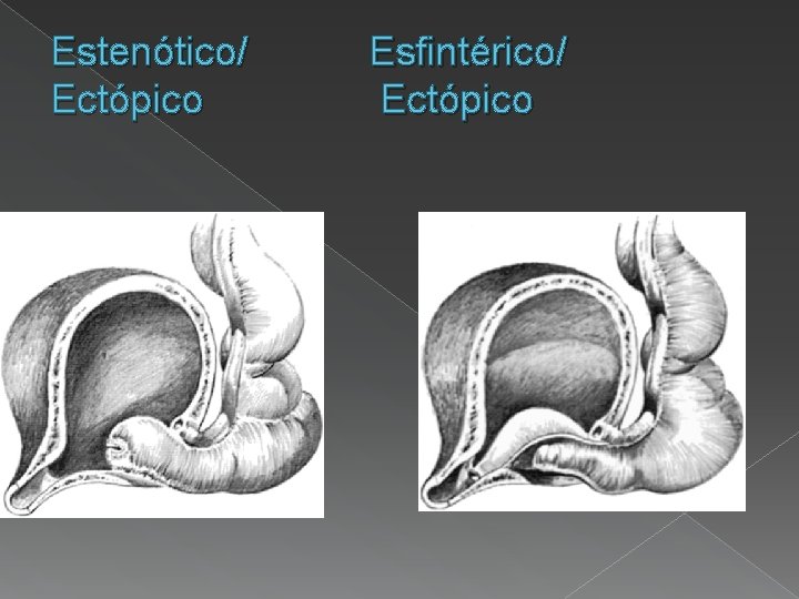 Estenótico/ Ectópico Esfintérico/ Ectópico 
