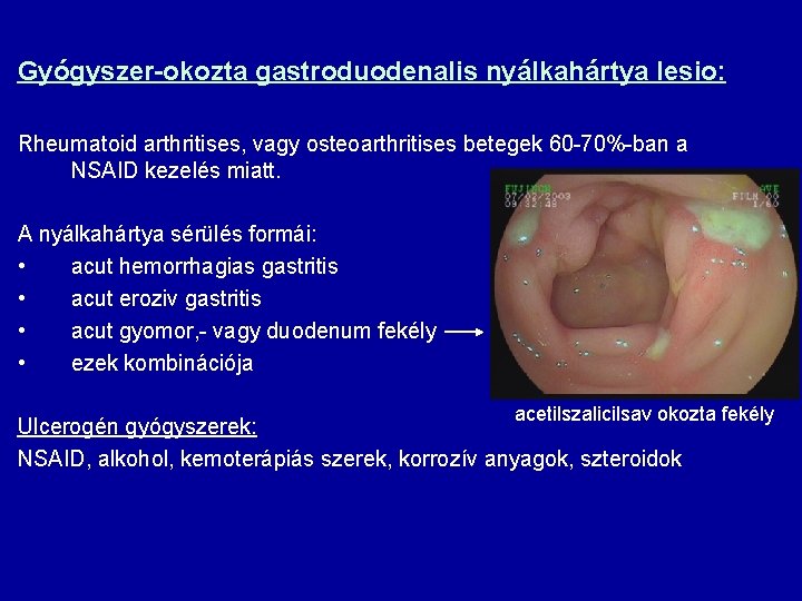Gyógyszer-okozta gastroduodenalis nyálkahártya lesio: Rheumatoid arthritises, vagy osteoarthritises betegek 60 -70%-ban a NSAID kezelés