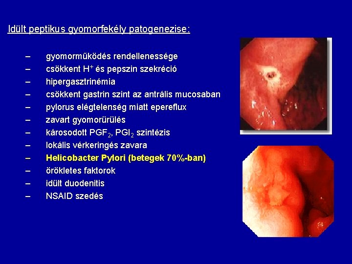 Idült peptikus gyomorfekély patogenezise: – – – gyomorműködés rendellenessége csökkent H+ és pepszin szekréció