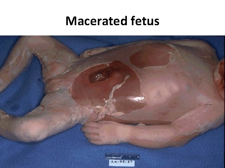 Macerated fetus 