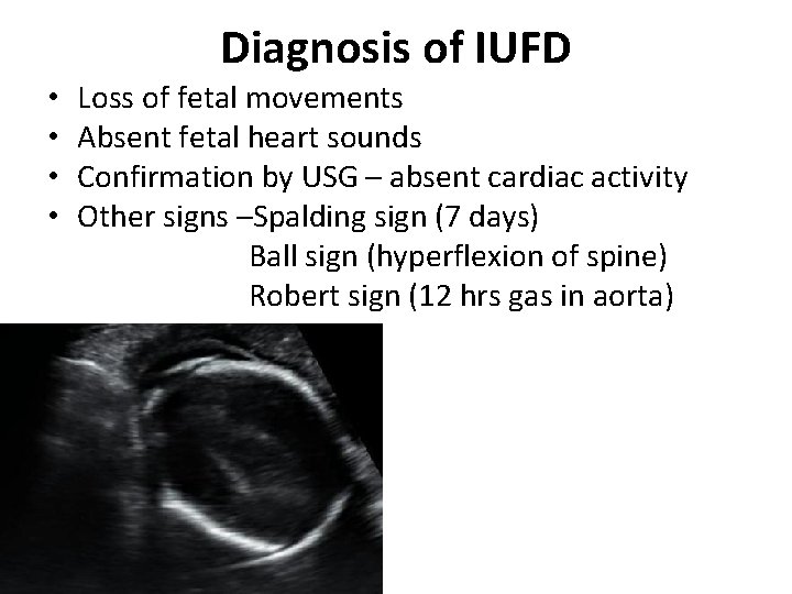 Diagnosis of IUFD • • • Loss of fetal movements Absent fetal heart sounds