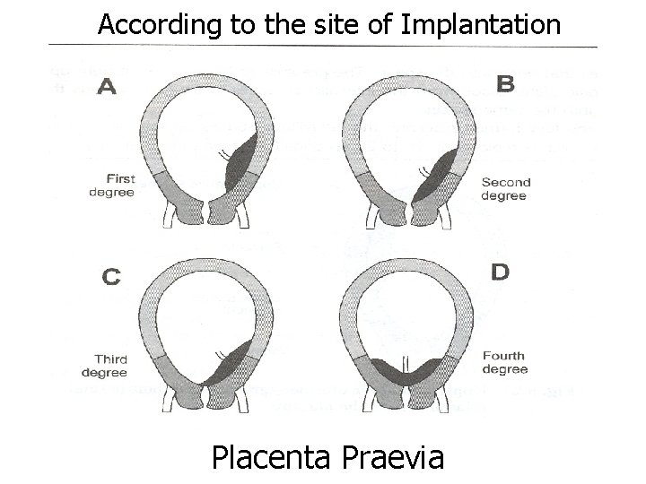 According to the site of Implantation Placenta Praevia 