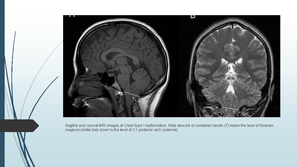 Sagittal and coronal MRI images of Chiari type I malformation. Note descent of cerebellar