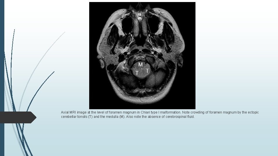 Axial MRI image at the level of foramen magnum in Chiari type I malformation.