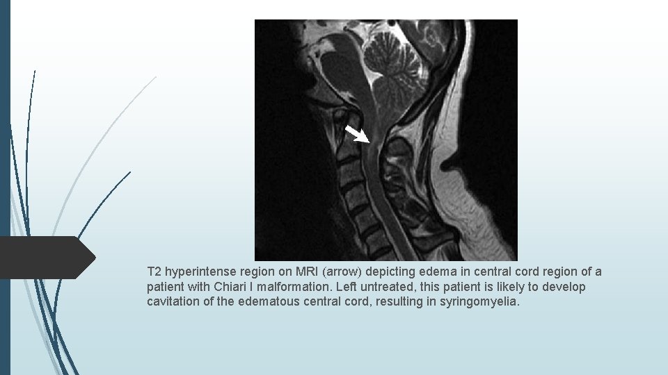 T 2 hyperintense region on MRI (arrow) depicting edema in central cord region of
