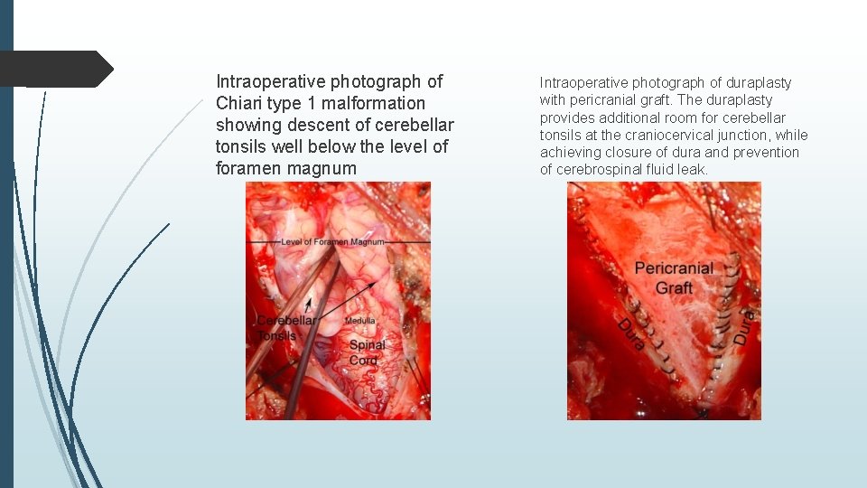 Intraoperative photograph of Chiari type 1 malformation showing descent of cerebellar tonsils well below