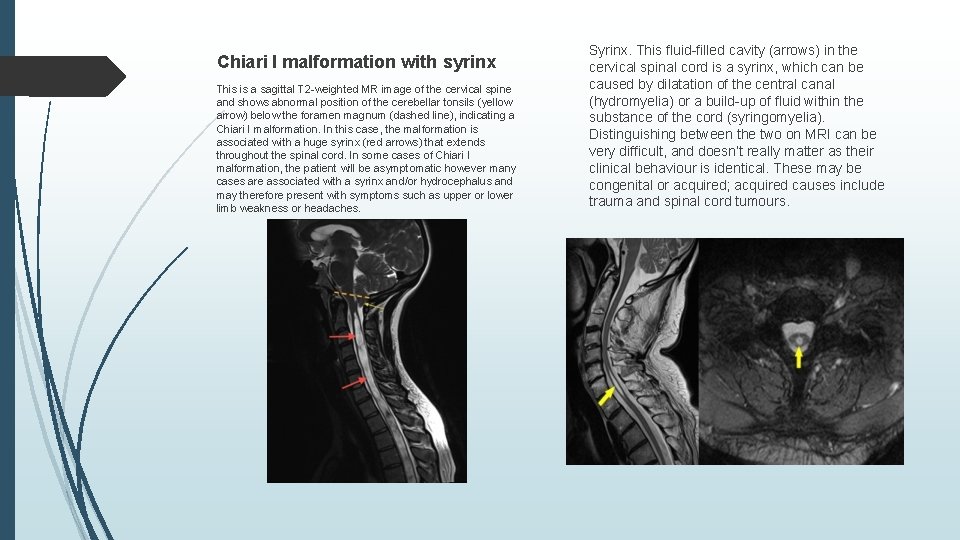 Chiari I malformation with syrinx This is a sagittal T 2 -weighted MR image