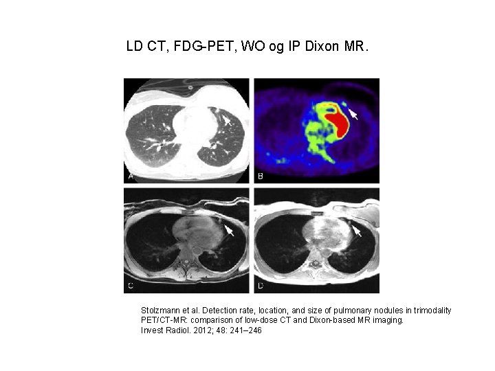 LD CT, FDG-PET, WO og IP Dixon MR. Stolzmann et al. Detection rate, location,