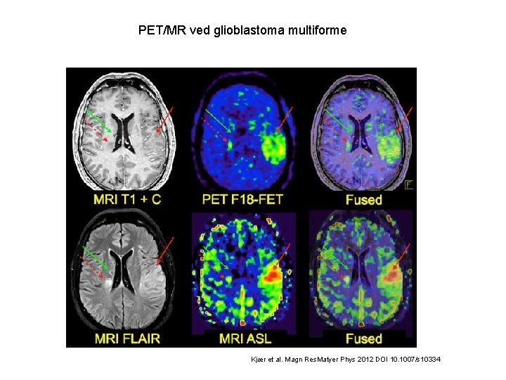 PET/MR ved glioblastoma multiforme Kjær et al. Magn Res. Matyer Phys 2012 DOI 10.