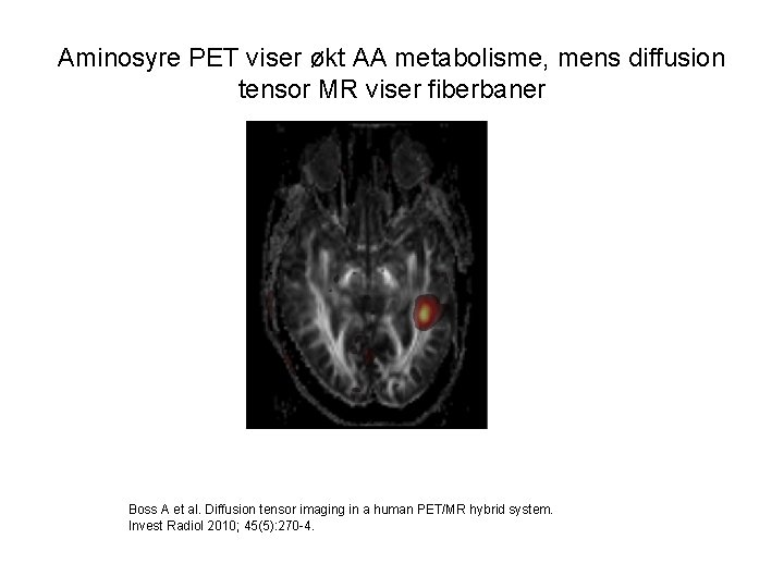 Aminosyre PET viser økt AA metabolisme, mens diffusion tensor MR viser fiberbaner Boss A
