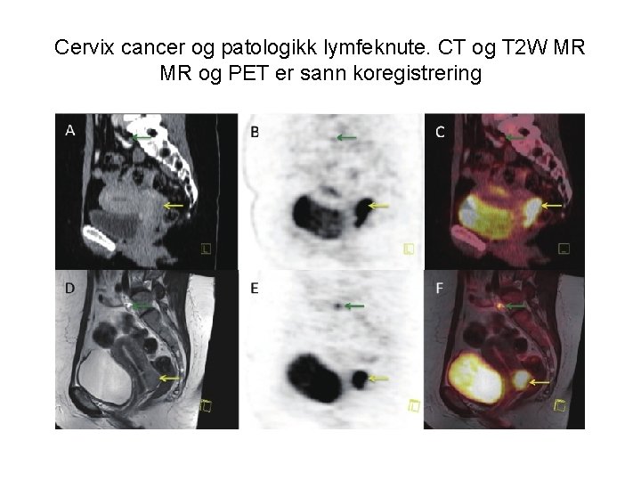 Cervix cancer og patologikk lymfeknute. CT og T 2 W MR MR og PET