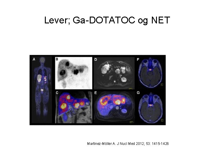 Lever; Ga-DOTATOC og NET Martinez-Möller A. J Nucl Med 2012; 53: 1415 -1426 