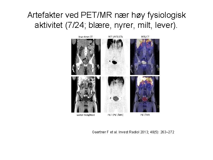 Artefakter ved PET/MR nær høy fysiologisk aktivitet (7/24; blære, nyrer, milt, lever). Gaertner F
