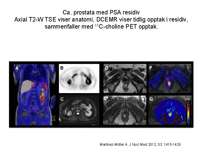 Ca. prostata med PSA residiv Axial T 2 -W TSE viser anatomi, DCEMR viser