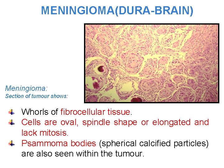 MENINGIOMA(DURA-BRAIN) Meningioma: Section of tumour shows: Whorls of fibrocellular tissue. Cells are oval, spindle